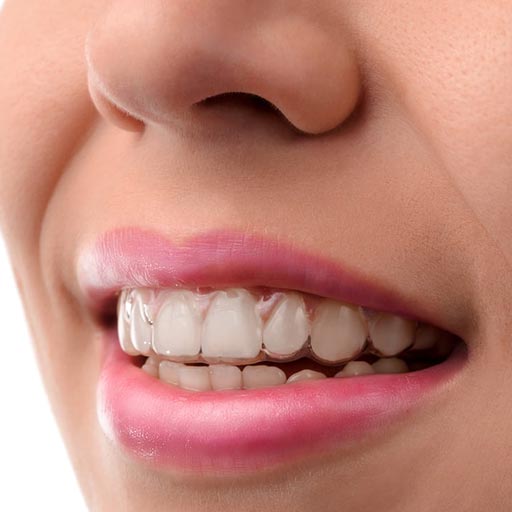 Gouttières transparentes Invisalign