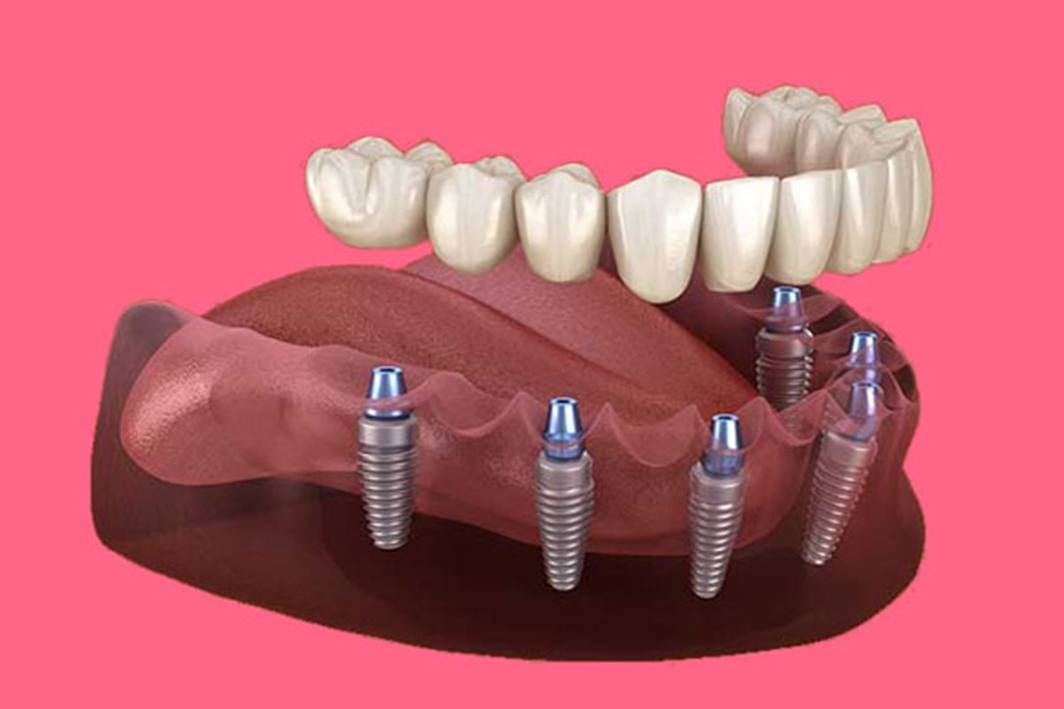 Combien coûte un implant dentaire à Casablanca ?