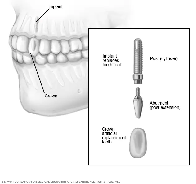 Implant dentaire