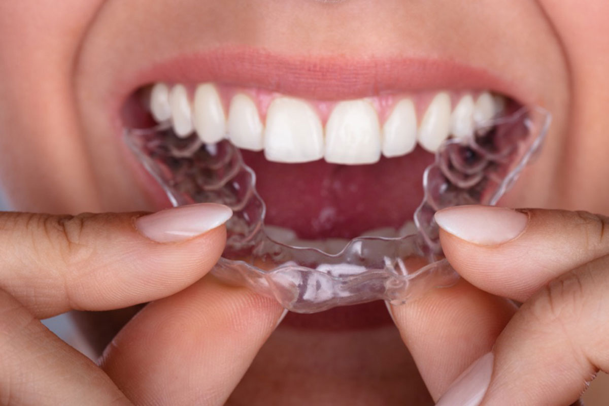Orthodontie invisible à Casablanca : avantages et limites
