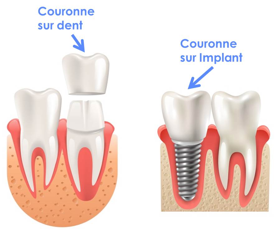 Couronne dentaire