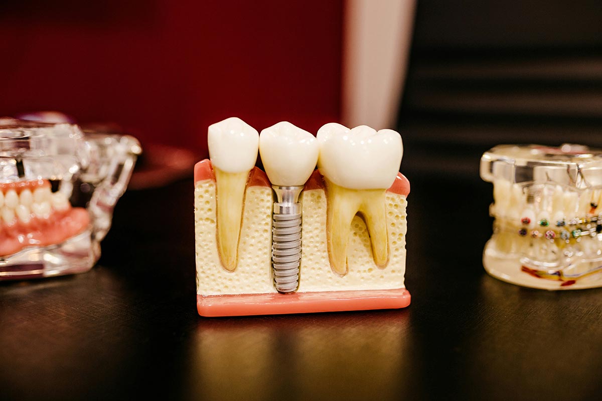 Implant dentaire vs bridge à Casablanca : comparaison complète