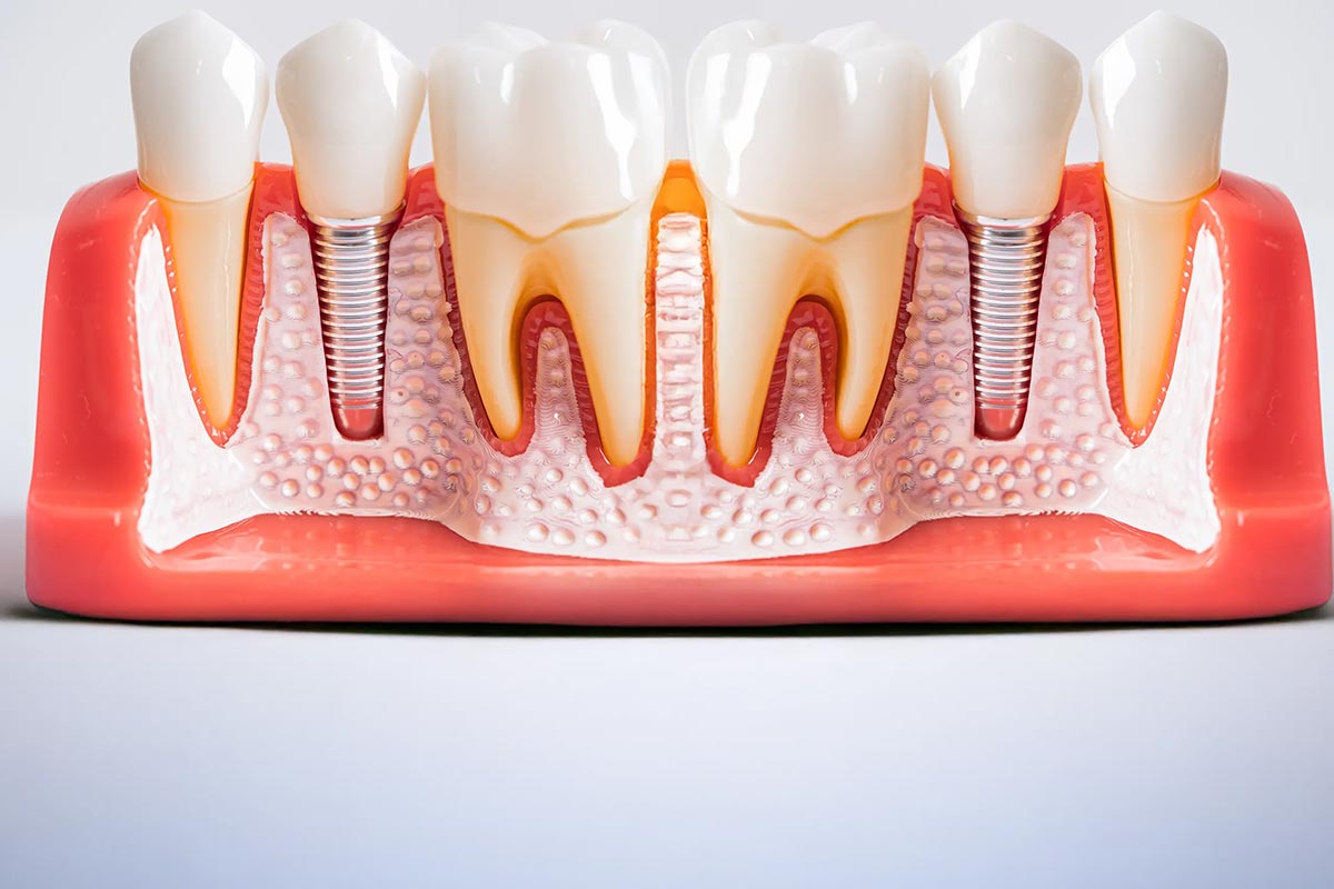 Prix d'un implant dentaire à Casablanca