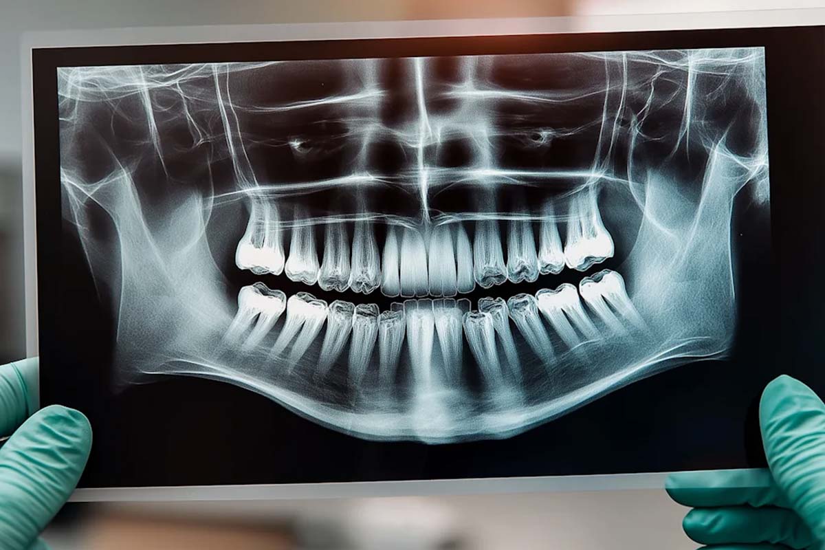 Radiographie dentaire à Casablanca: guide comple